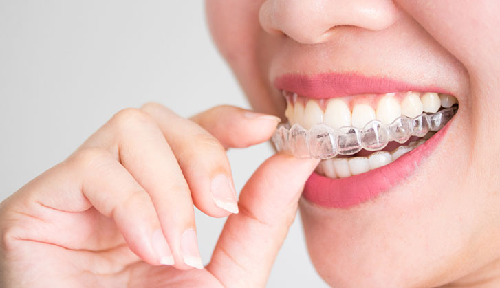Advantages Of Invisalign Trays Over Other Conventional Orthodontic  treatments  Home - Dental Clinic In Dubai, Dentist In Dubai, Cosmetic  Dentistry, Dental Implants, Root Canal Treatment RCT, Teeth Whitening,  Dental Braces, Veneers