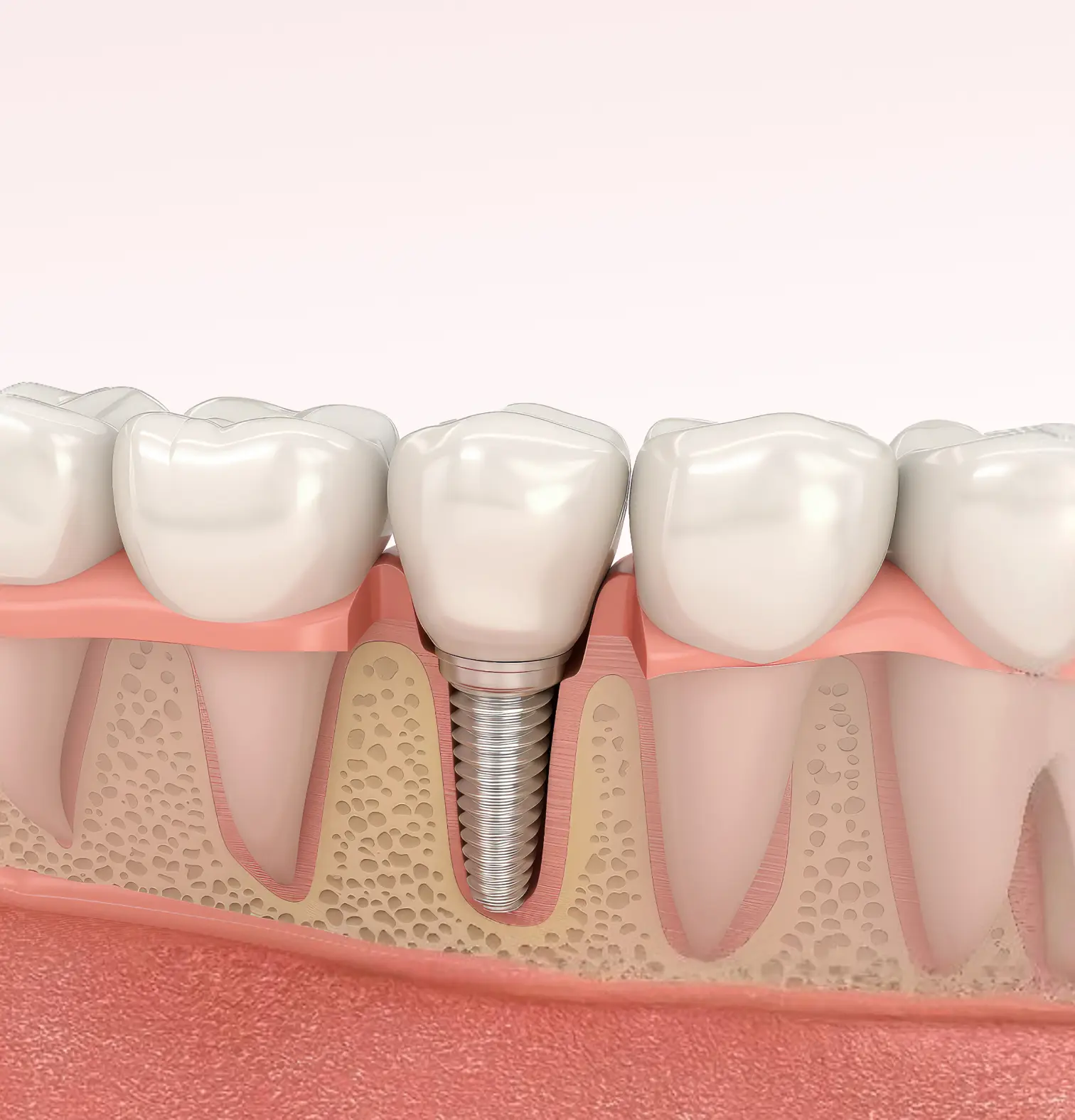 Dental-Implants-teeth