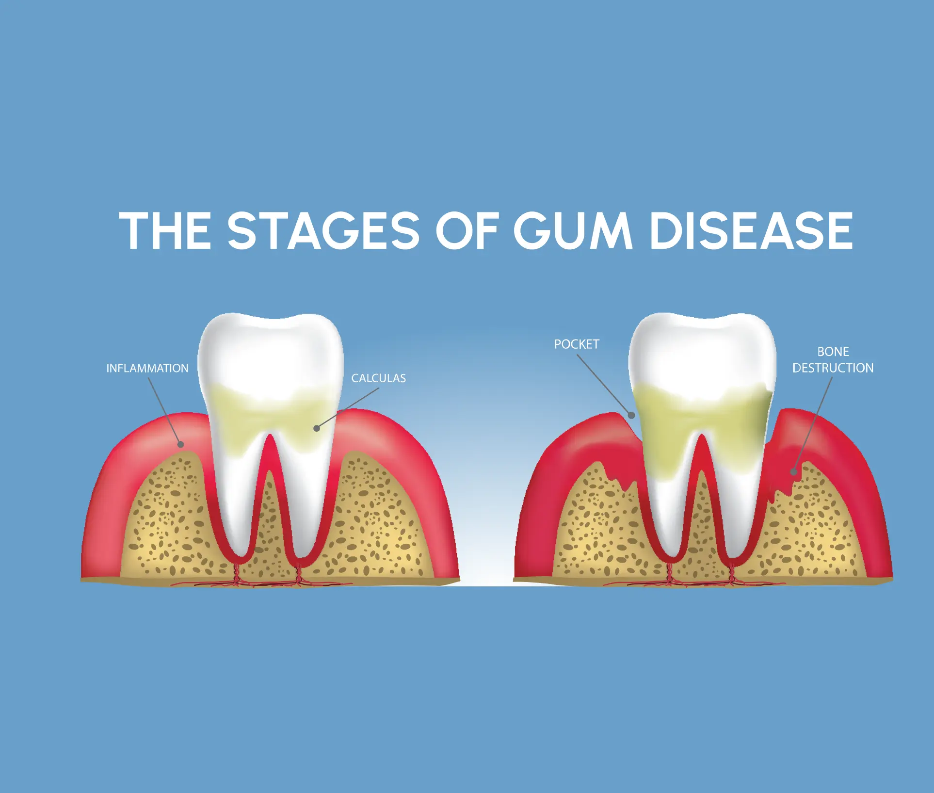 Periodontitis