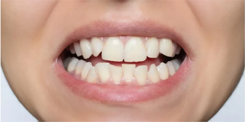 before-teeth