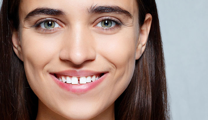 All You Wanted To  Know About Fixing Teeth Gaps