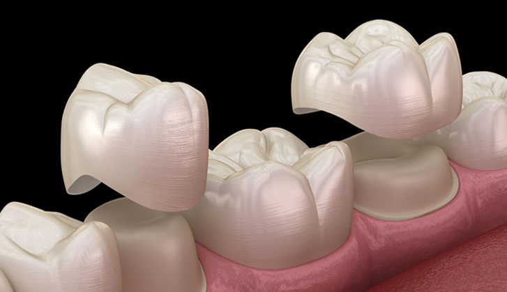 All You Need To Know About Porcelain Crowns