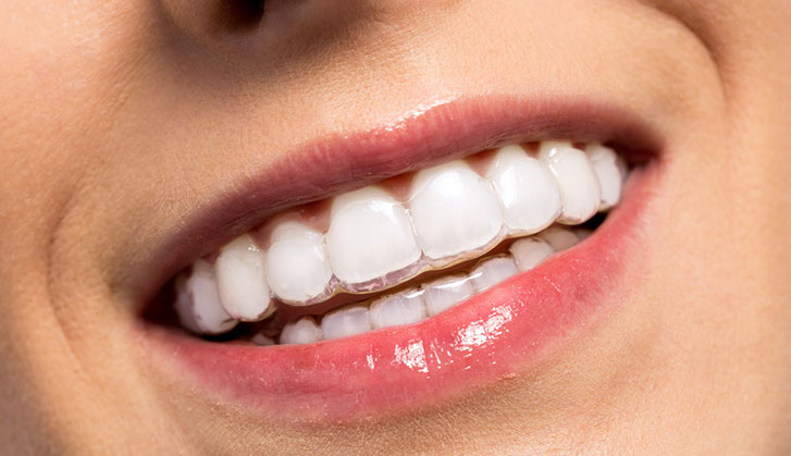 5 Surprising Benefits Of Lingual Braces