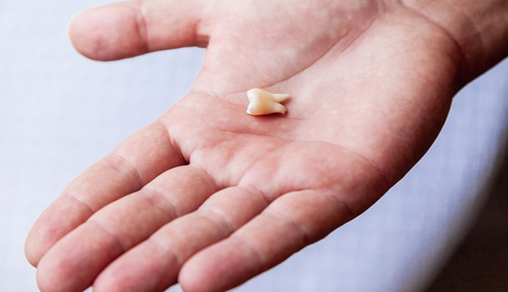 5 Reasons Why You Should Replace Your Lost Tooth