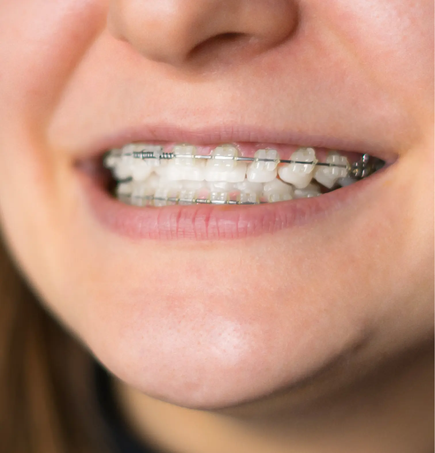 Ceramic-Braces