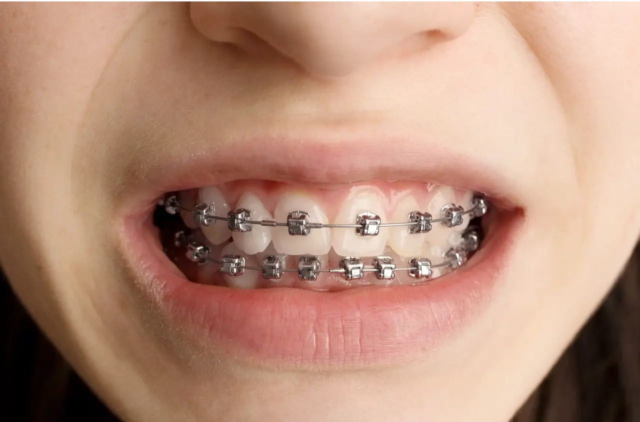 Damon Braces