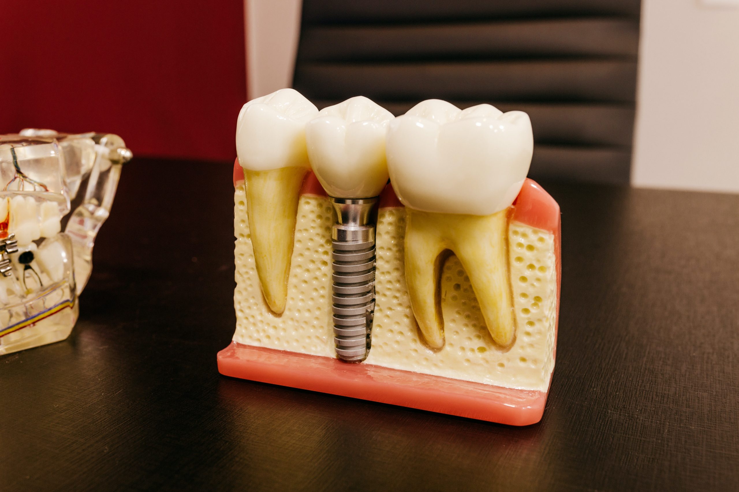 Who Cannot Get Dental Implants?