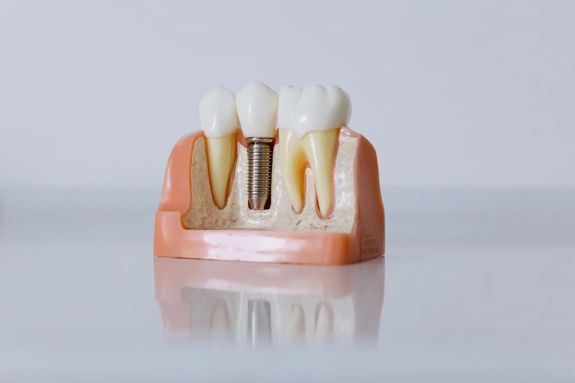 Dental Implants vs Dentures – Which One Is Better?