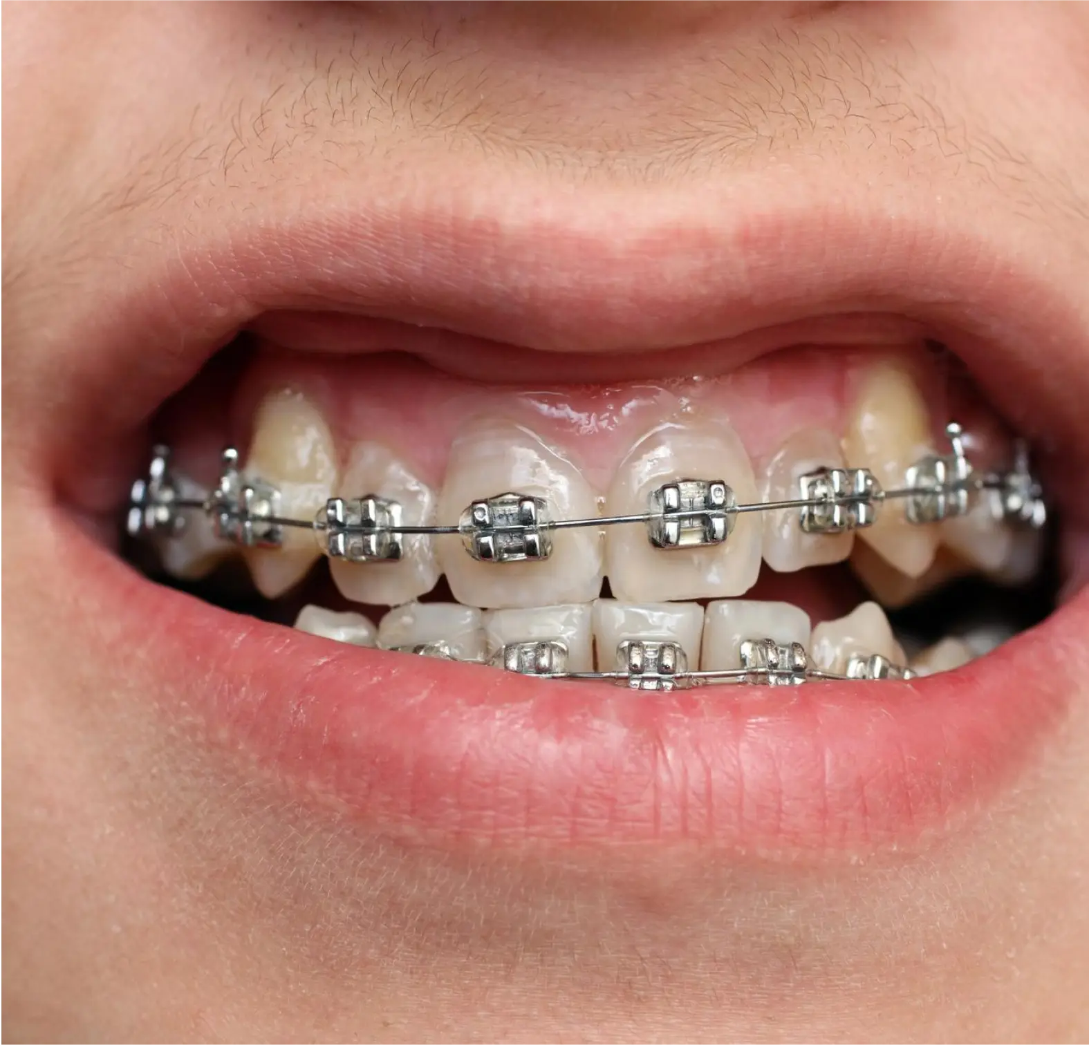 Metal-Braces