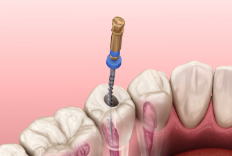 Endodontics / Root Canal Treatment