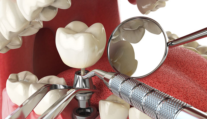 What Are the Different Types of Dental Implants?