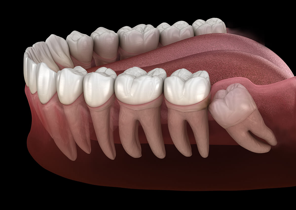 When and Why Wisdom Tooth Removal is Necessary and Can it Be Prevented?