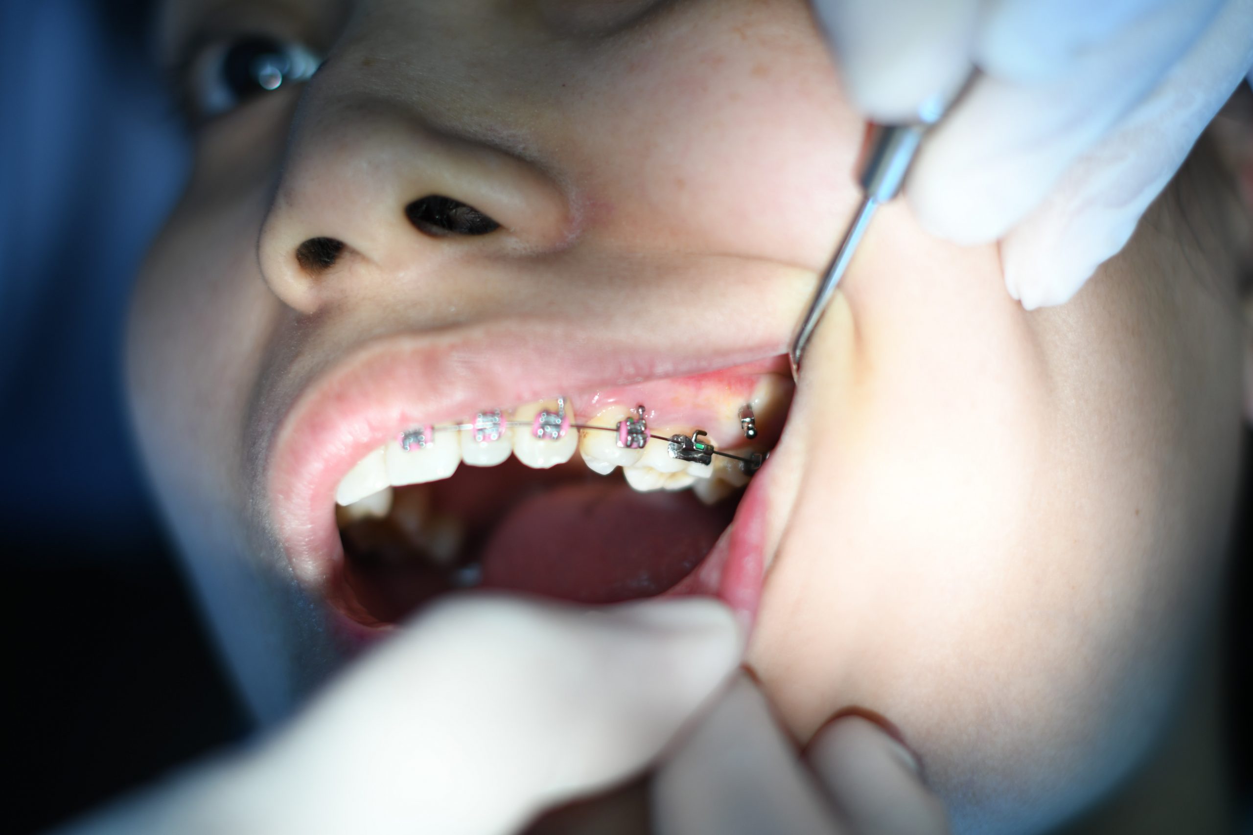 Dental Braces in Dubai | All You Need To Know