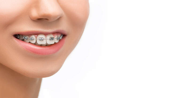 Dental Braces for Adults