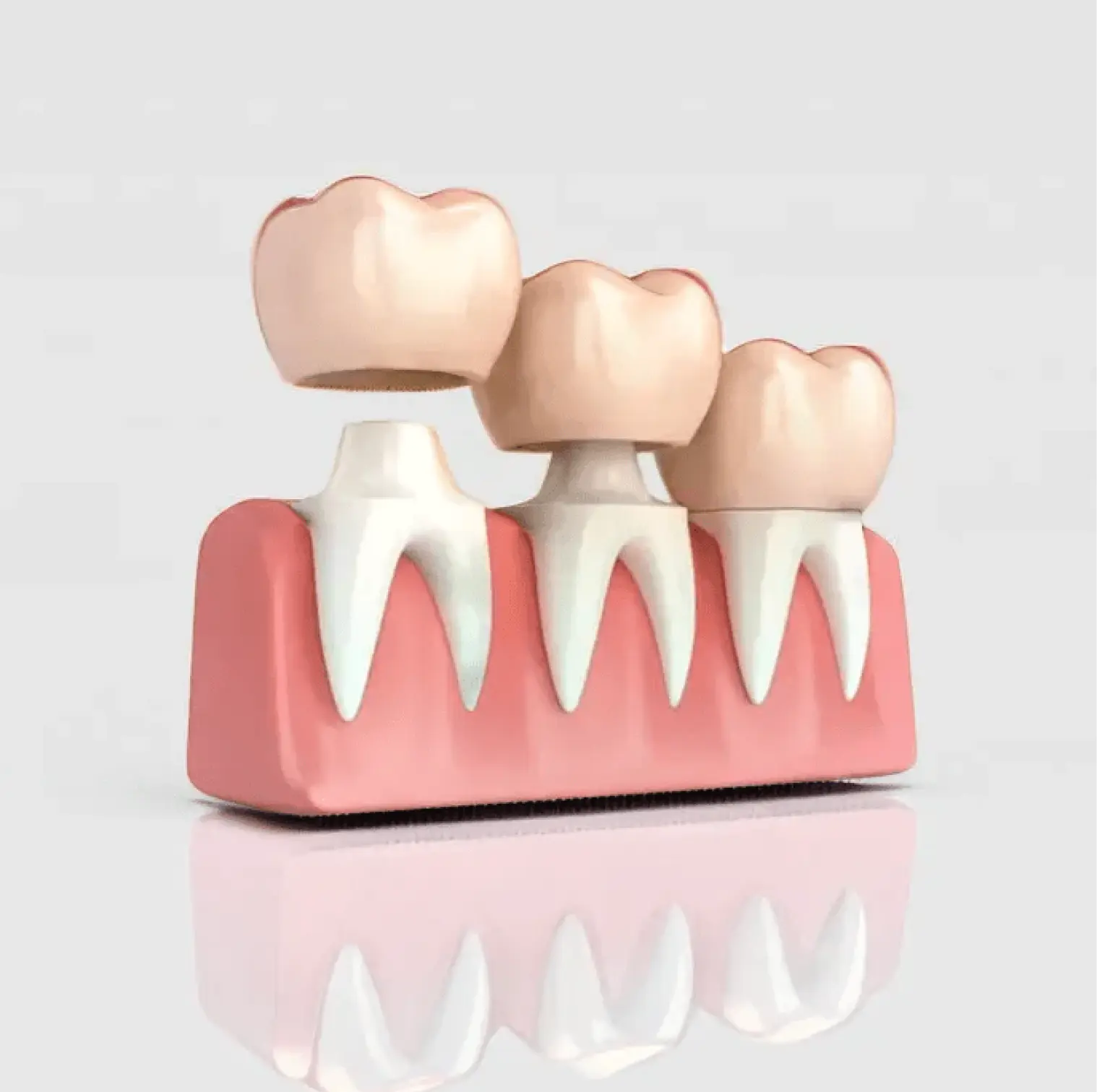 dental-crown