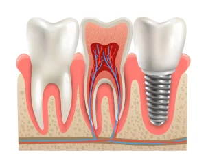 all-on-4 and all on-6 dental implants