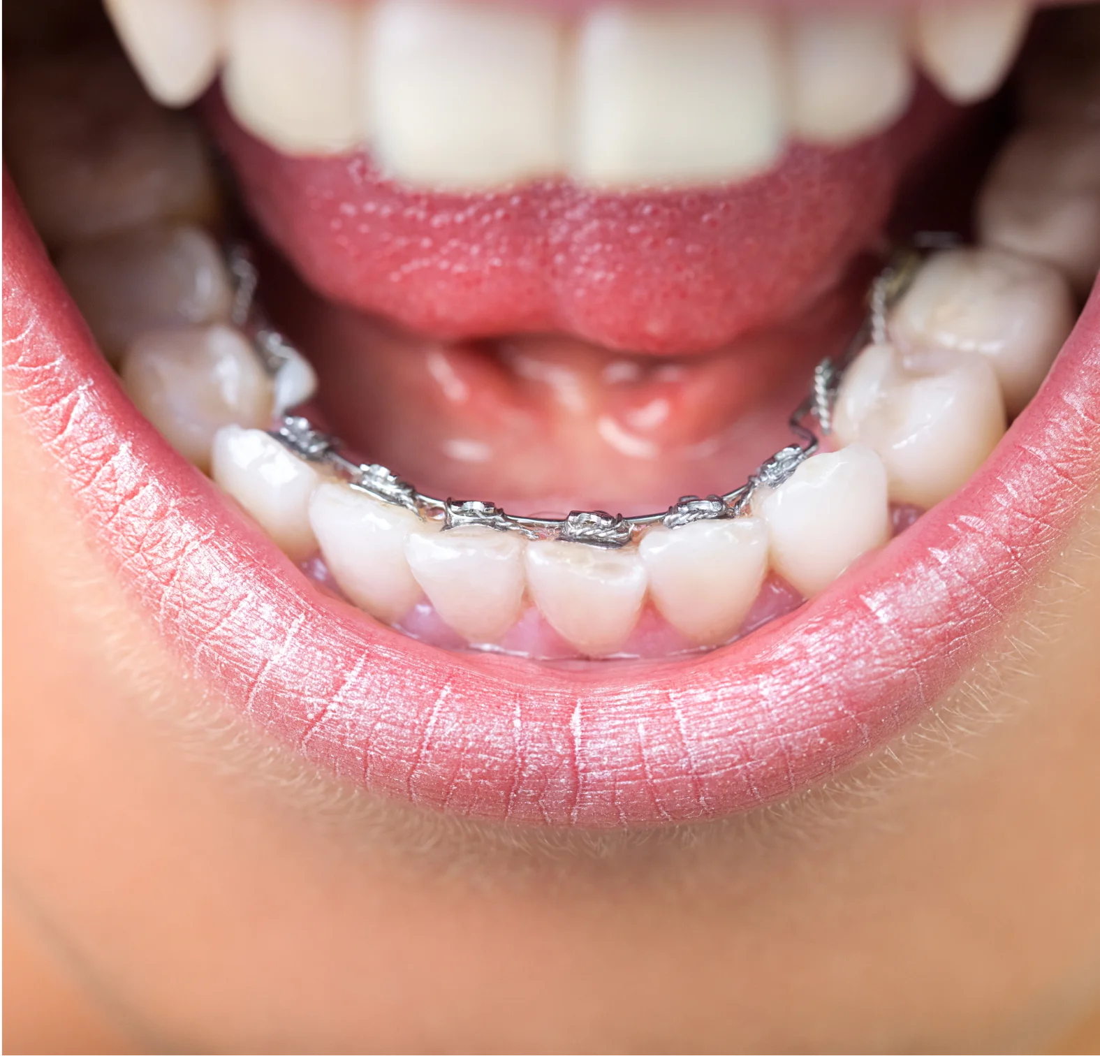 invisible-lingual-braces