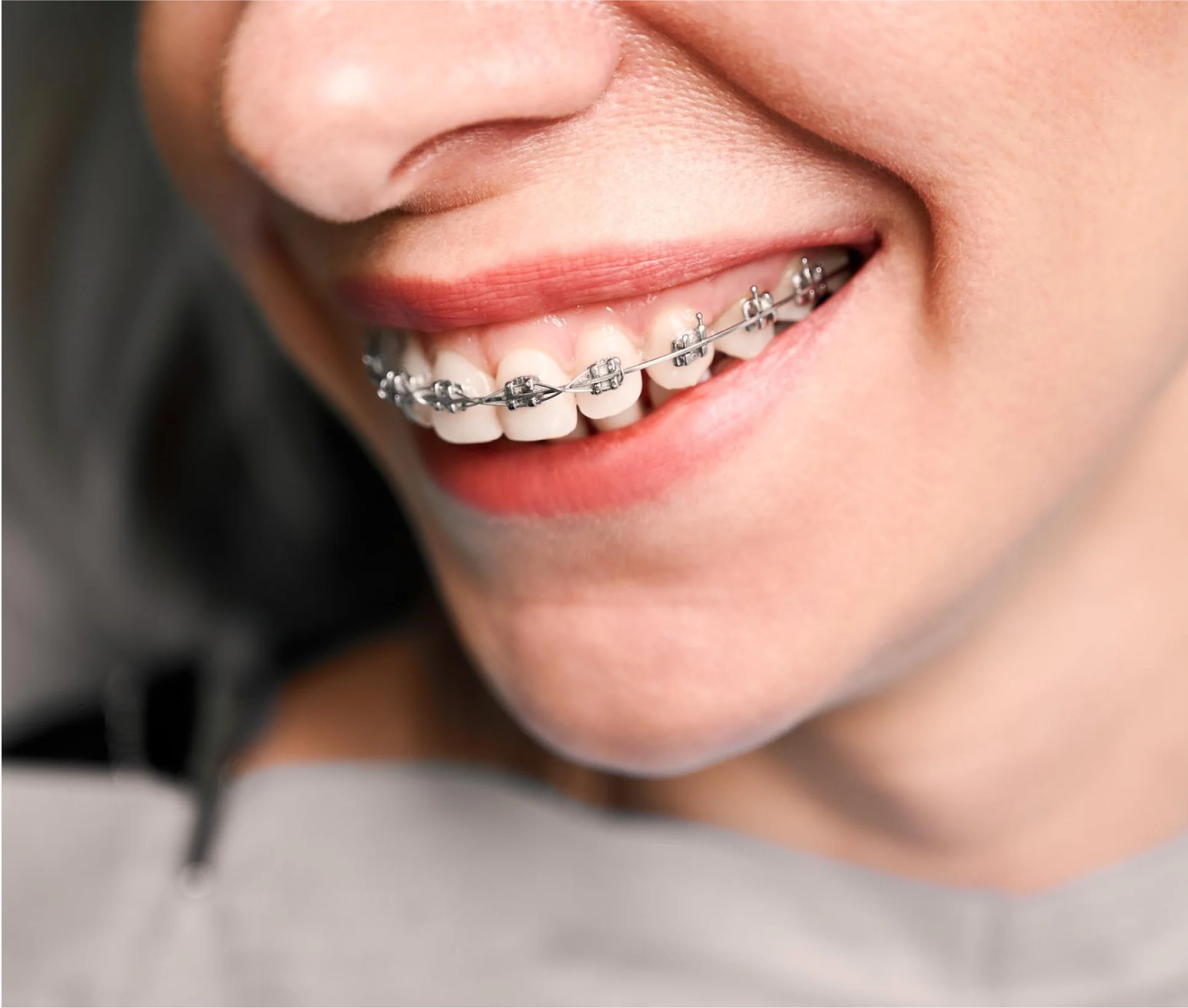 metal-braces