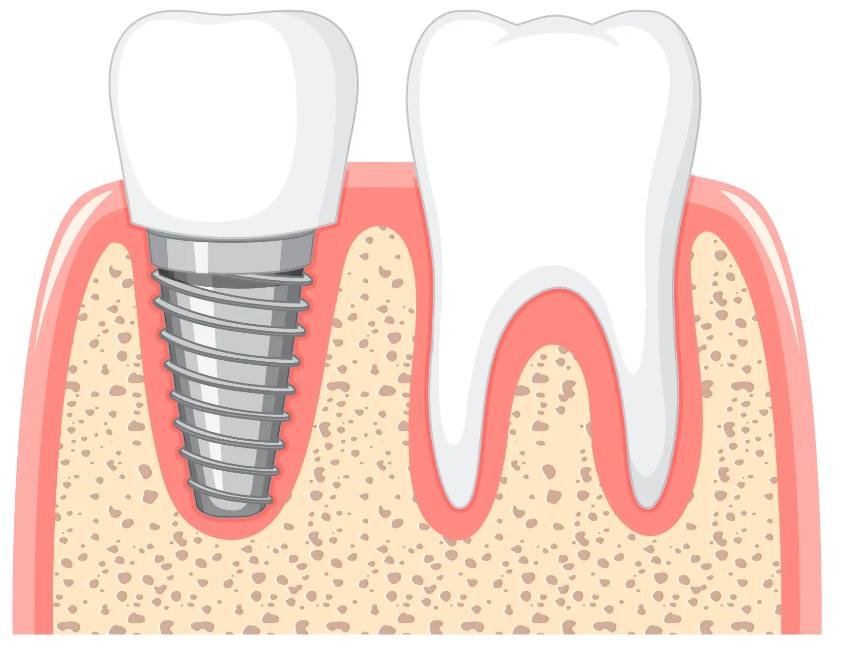 why dental implants