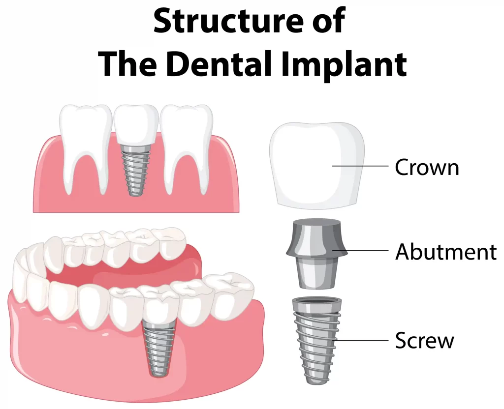 why dental implants