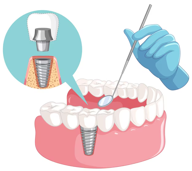 dental implants picturization