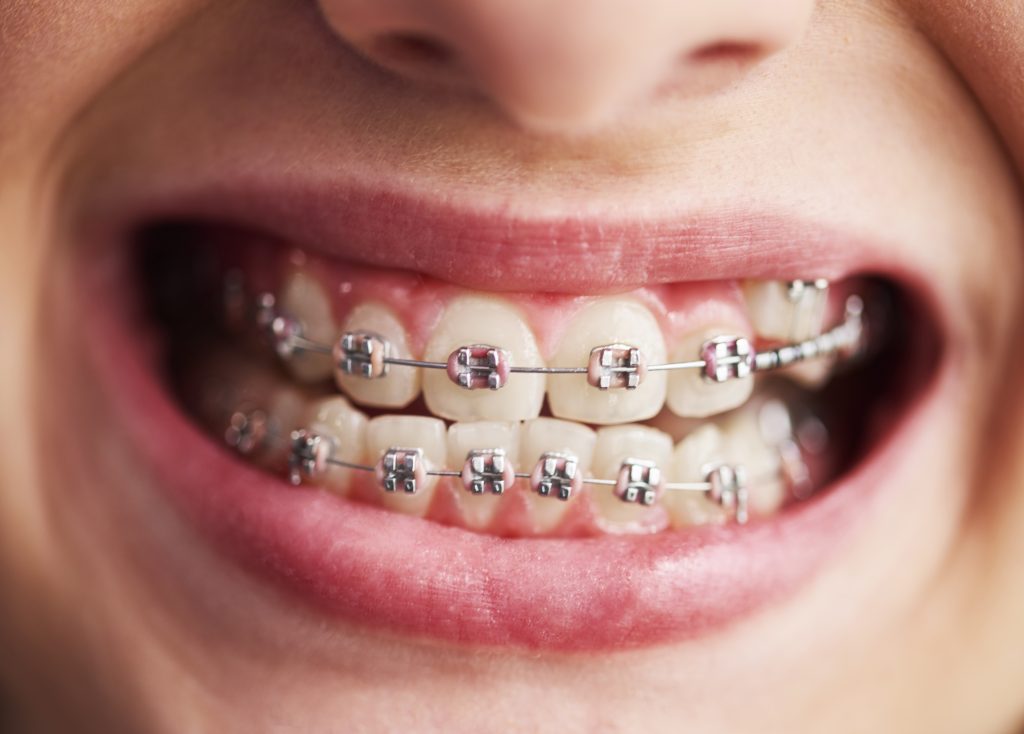 Child's Teeth with Braces