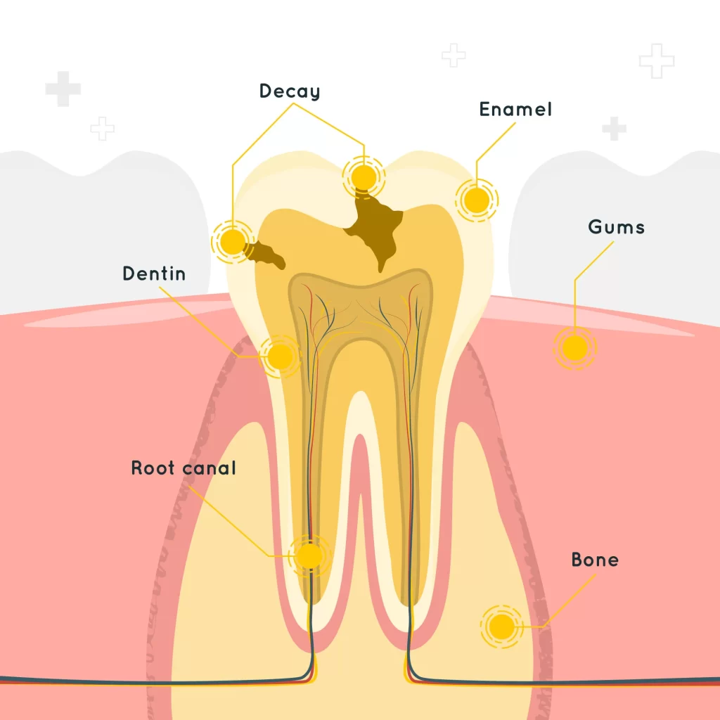 Illustration of a tooth structure highlighting decay, enamel, dentin, root canal, gums, and bone to explain reasons for root canal treatments.