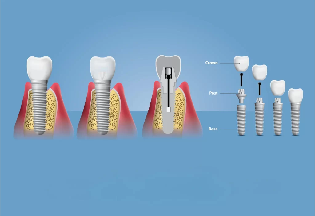 Illustration showing the structure of dental implants, including the crown, post, and base, with step-by-step assembly in the jawbone.