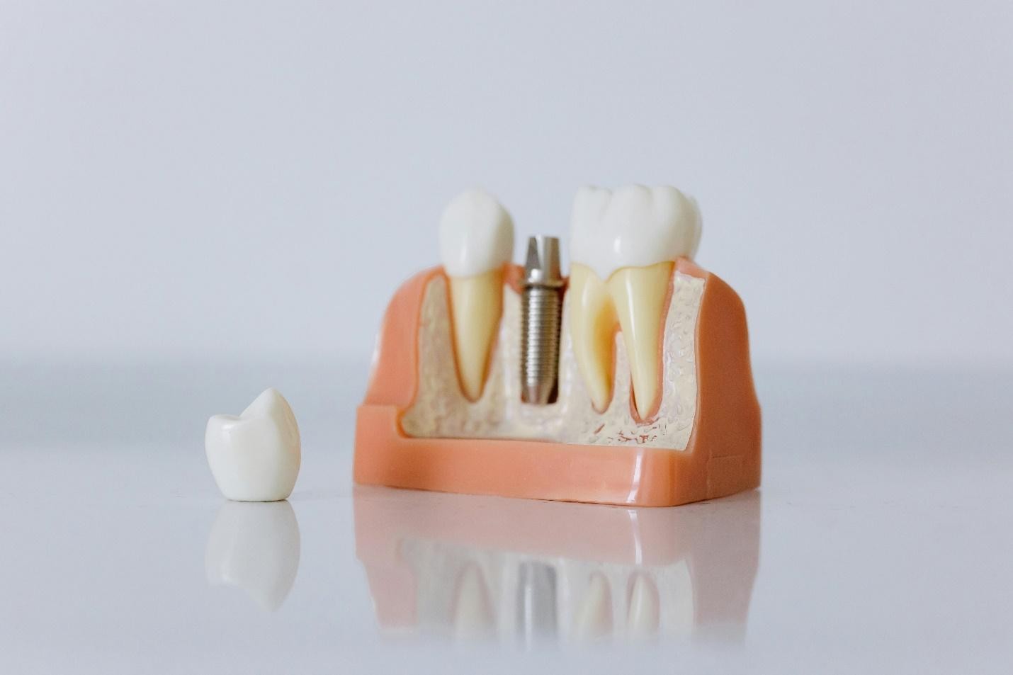 Why Choose Dental Implants for Missing Teeth