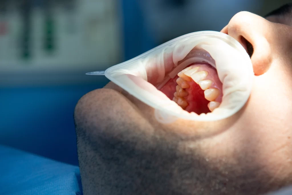 Close-up view of a dental procedure focusing on the patient's open mouth, highlighting guided tissue regeneration treatment with protective tools in place.