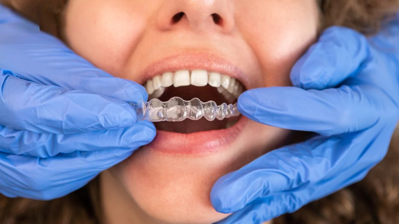 What to Expect from Invisalign Treatment